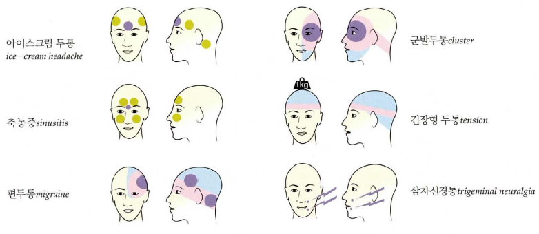 두통 종류에 따른 통증 부위