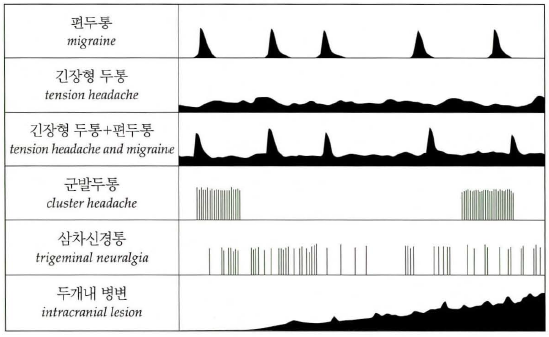 두통 종류에 따른 통증 양상