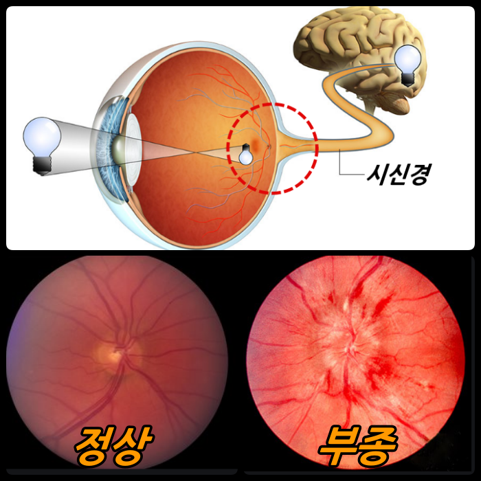 뇌압 상승에서 시신경유두부종