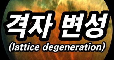 망막 격자변성(lattice degeneration) - 망막 주변부 변성 7