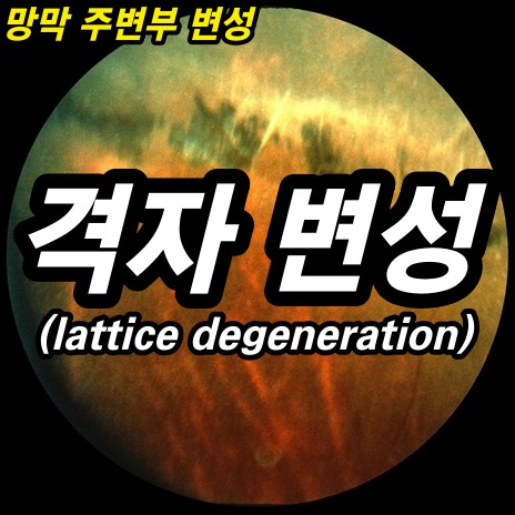 망막 격자변성(lattice degeneration) - 망막 주변부 변성 7