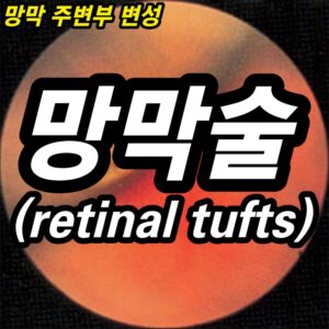 망막술(retinal tufts) - 망막 주변부 변성 8