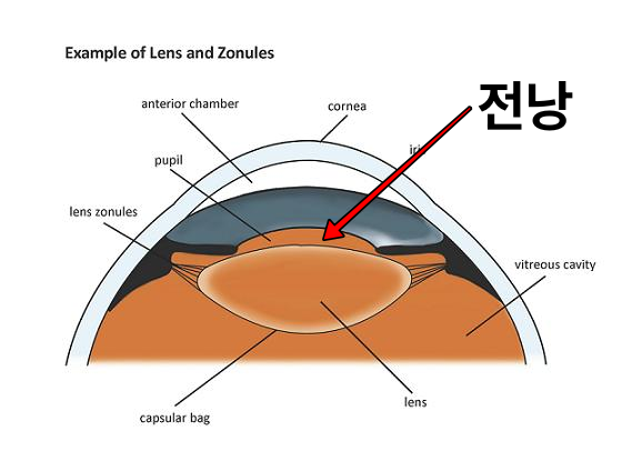 딱딱한 백내장 술기 part1 - 전낭염색