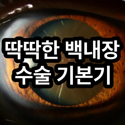 딱딱한 백내장 수술의 기본 접근 방법 