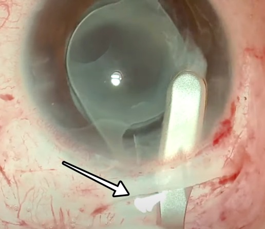 인공수정체 제거 방법: 공막고정술을 위한 첫 단계