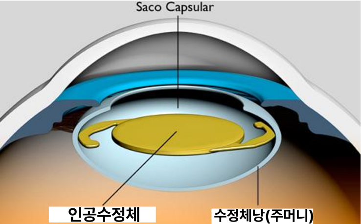 인공수정체 탈구, 아탈구: 수정체낭 지지가 부족한 경우의 수술법