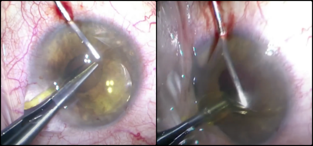 인공수정체 제거 방법: 공막고정술을 위한 첫 단계