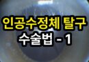 인공수정체 탈구, 아탈구: 수정체낭 지지가 부족한 경우의 수술법