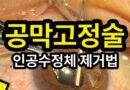 인공수정체 제거 방법: 공막고정술을 위한 첫 단계