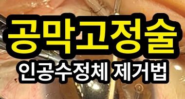 인공수정체 제거 방법: 공막고정술을 위한 첫 단계