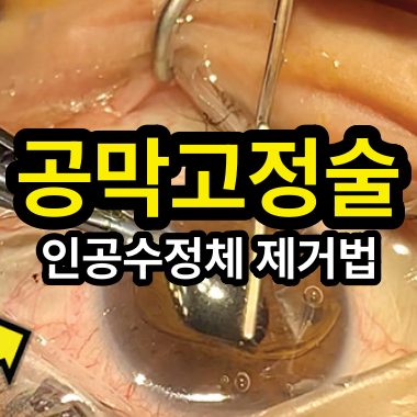 인공수정체 제거 방법: 공막고정술을 위한 첫 단계