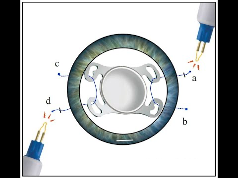 공막고정술 : 카나브라바 테크닉 (Four-Flanged Intrascleral IOL Fixation)