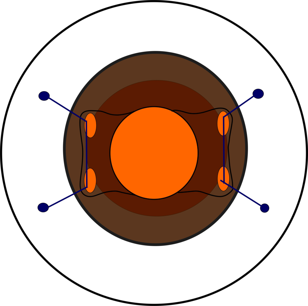 공막고정술 : 카나브라바 테크닉 (Four-Flanged Intrascleral IOL Fixation)