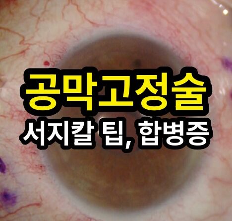 인공수정체 탈구: 야마네 테크닉에서 알아야 할 팁과 합병증 관리