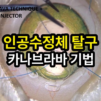 공막고정술 : 카나브라바 테크닉 (Four-Flanged Intrascleral IOL Fixation)