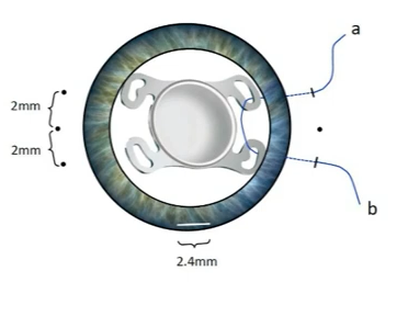 공막고정술 : 카나브라바 테크닉 (Four-Flanged Intrascleral IOL Fixation)