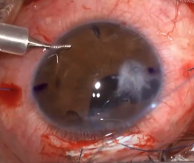 공막고정술 : 카나브라바 테크닉 (Four-Flanged Intrascleral IOL Fixation)