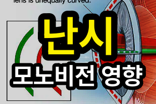 모노비전 백내장 수술시 난시