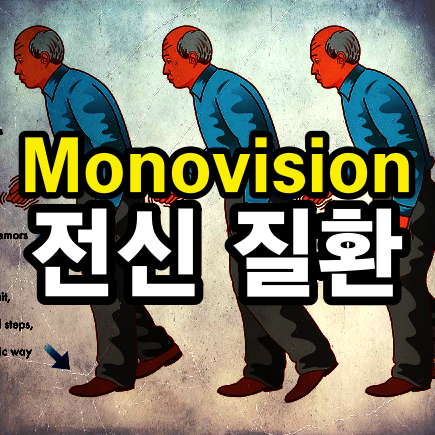 백내장 모노비전, 어떤 경우 피해야 할까?(전신)