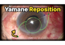 야마네 인공수정체 기울어짐 재고정