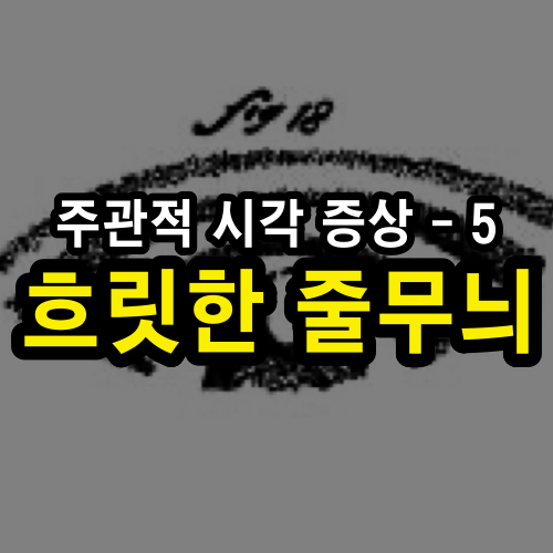 주관적 시각 증상 5 – 떠다니는 흐릿한 줄무늬 (Wandering Cloudy Stripes)